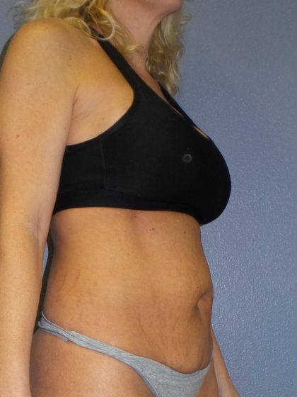 Abdominoplasty Before & After Patient #2080