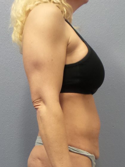 Abdominoplasty Before & After Patient #2080