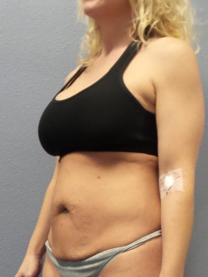Abdominoplasty Before & After Patient #2080