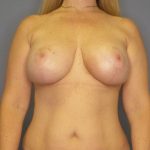 Mastopexy (Breast Lift) Before & After Patient #774