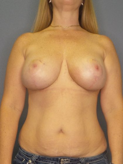 Mastopexy (Breast Lift) Before & After Patient #774