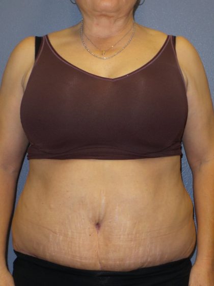 Abdominoplasty Before & After Patient #2229