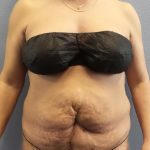 Abdominoplasty Before & After Patient #2229
