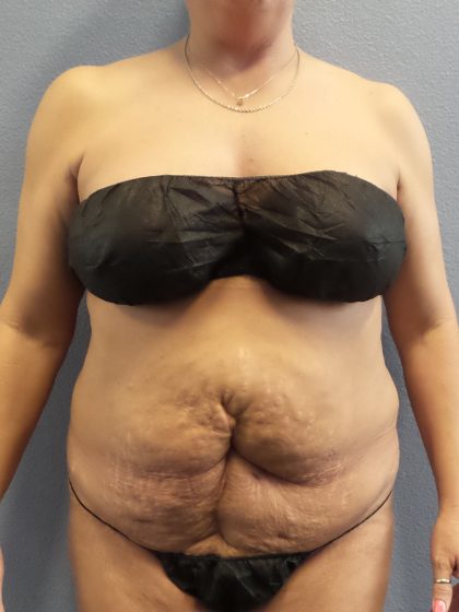 Abdominoplasty Before & After Patient #2229