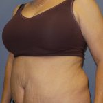 Abdominoplasty Before & After Patient #2229