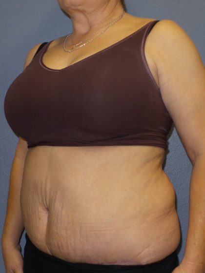 Abdominoplasty Before & After Patient #2229