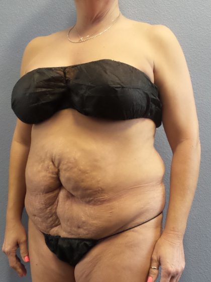 Abdominoplasty Before & After Patient #2229