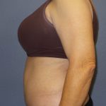 Abdominoplasty Before & After Patient #2229