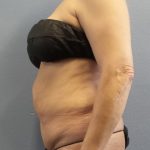 Abdominoplasty Before & After Patient #2229
