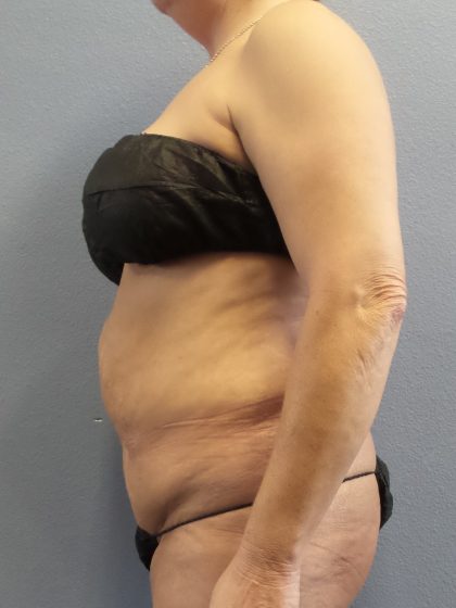Abdominoplasty Before & After Patient #2229
