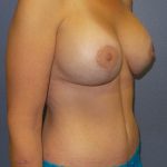 Mommy Makeover Before & After Patient #2015