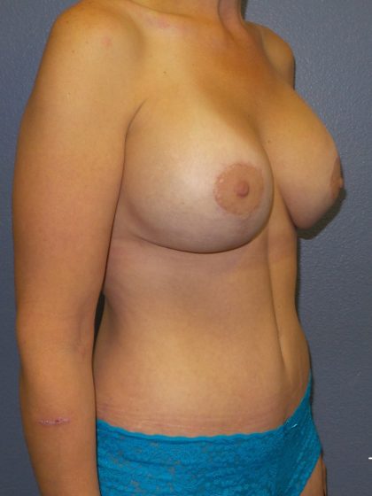 Mommy Makeover Before & After Patient #2015