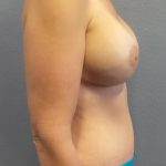 Mommy Makeover Before & After Patient #2015