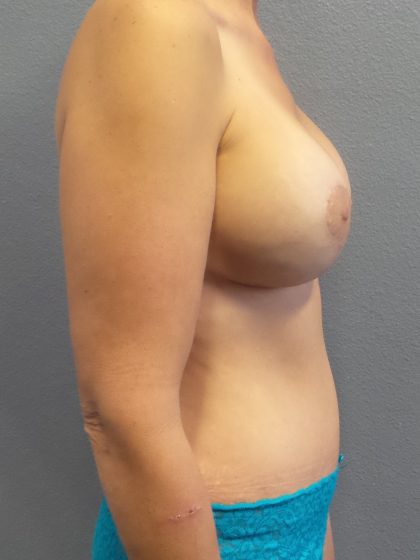 Mommy Makeover Before & After Patient #2015