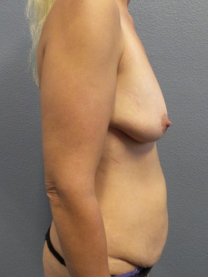Mommy Makeover Before & After Patient #2015