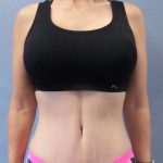 Abdominoplasty Before & After Patient #2091