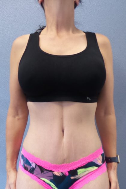Abdominoplasty Before & After Patient #2091