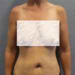 Abdominoplasty Before & After Patient #2091