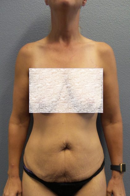Abdominoplasty Before & After Patient #2091