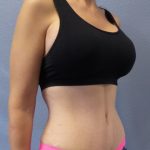 Abdominoplasty Before & After Patient #2091