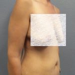 Abdominoplasty Before & After Patient #2091