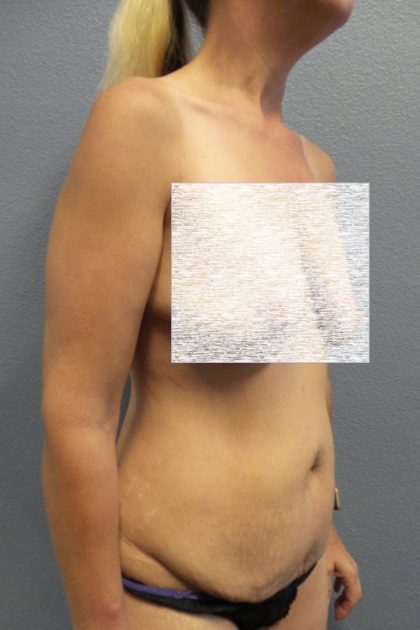 Abdominoplasty Before & After Patient #2091