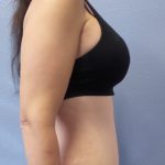 Abdominoplasty Before & After Patient #2091
