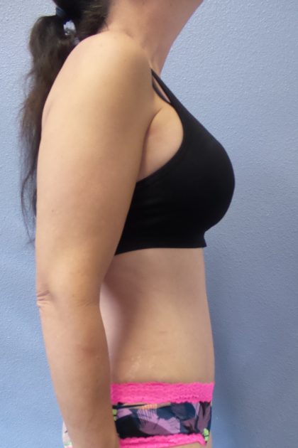 Abdominoplasty Before & After Patient #2091