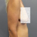 Abdominoplasty Before & After Patient #2091