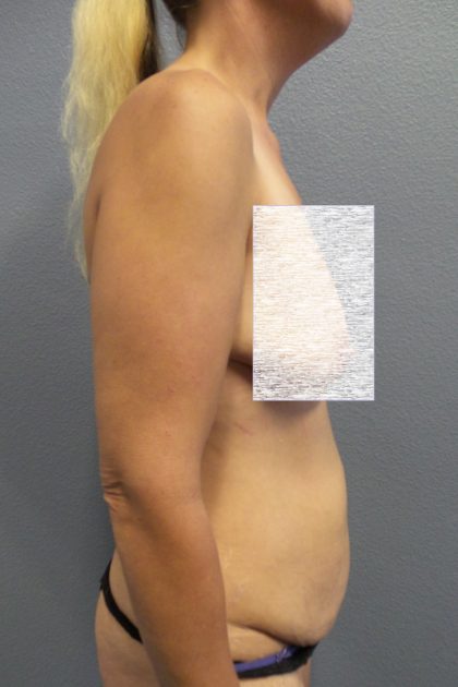 Abdominoplasty Before & After Patient #2091
