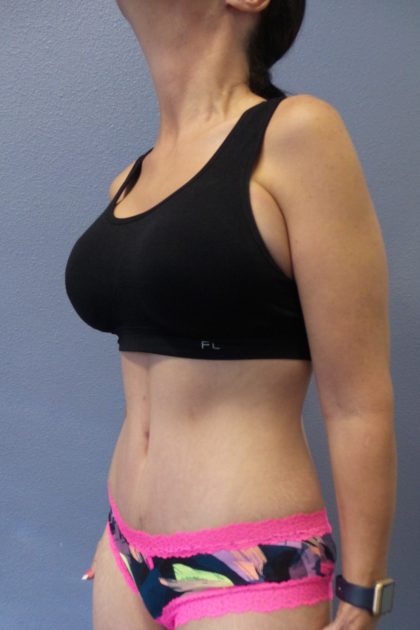 Abdominoplasty Before & After Patient #2091