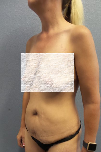 Abdominoplasty Before & After Patient #2091