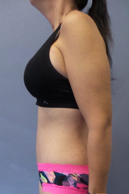 Abdominoplasty Before & After Patient #2091
