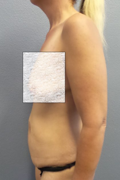 Abdominoplasty Before & After Patient #2091