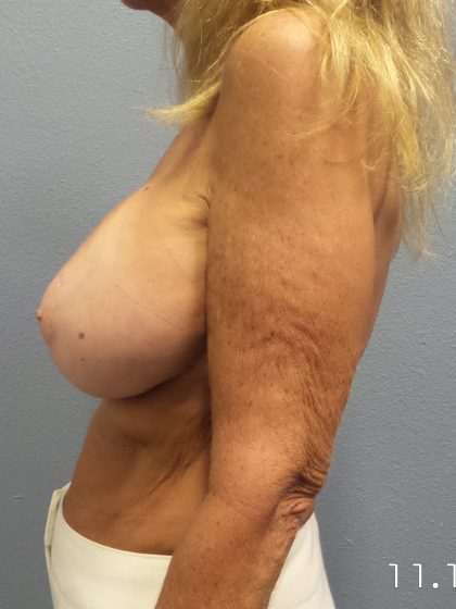Breast Augmentation Revision (Breast Enlargement Repair) Before & After Patient #651