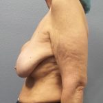 Breast Augmentation Revision (Breast Enlargement Repair) Before & After Patient #651