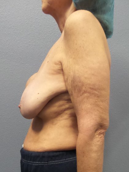 Breast Augmentation Revision (Breast Enlargement Repair) Before & After Patient #651