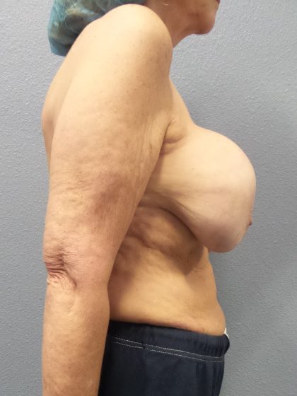 Breast Augmentation Revision (Breast Enlargement Repair) Before & After Patient #651