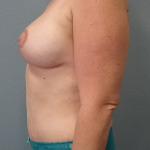 Mastopexy (Breast Lift) Before & After Patient #756