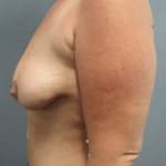 Mastopexy (Breast Lift) Before & After Patient #756