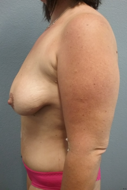 Mastopexy (Breast Lift) Before & After Patient #756