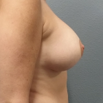 Mastopexy (Breast Lift) Before & After Patient #810