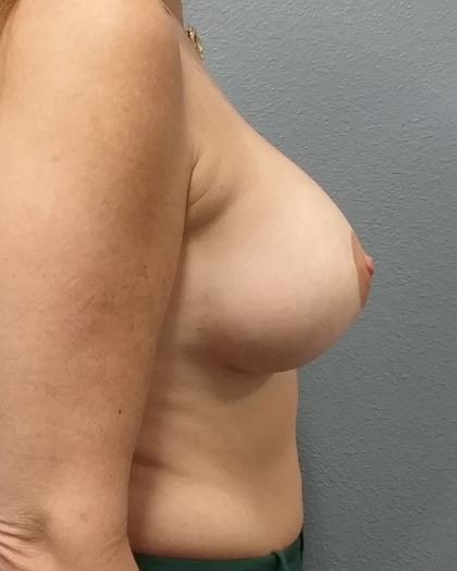 Mastopexy (Breast Lift) Before & After Patient #810