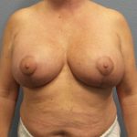 Mastopexy (Breast Lift) Before & After Patient #749