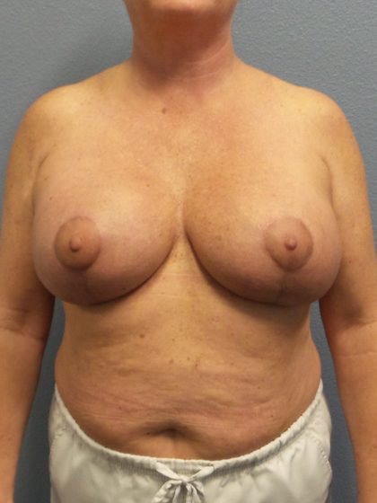 Mastopexy (Breast Lift) Before & After Patient #749