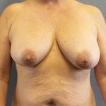 Mastopexy (Breast Lift) Before & After Patient #749