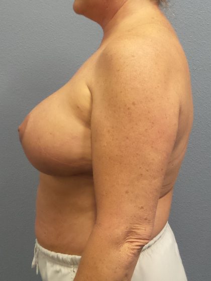 Mastopexy (Breast Lift) Before & After Patient #749