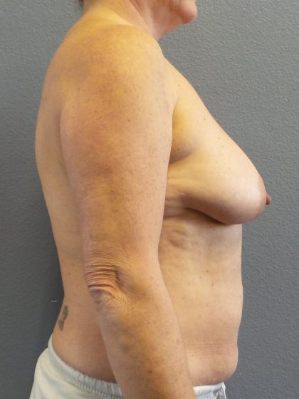 Mastopexy (Breast Lift) Before & After Patient #749