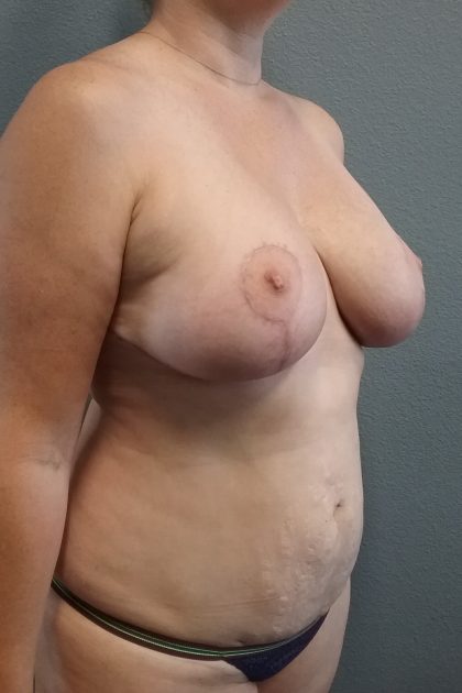Mastopexy (Breast Lift) Before & After Patient #817