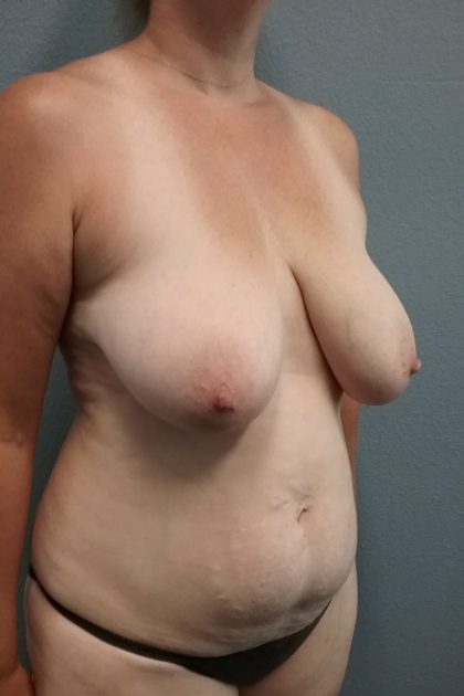 Mastopexy (Breast Lift) Before & After Patient #817